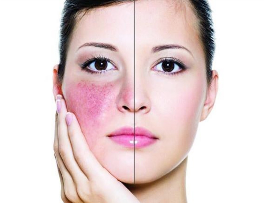 A closer look at Rosacea